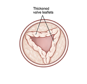 Top view of open pulmonary valve with thickened leaflets.