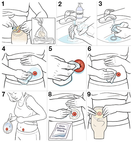 9 steps for caring for your stoma and the skin around it