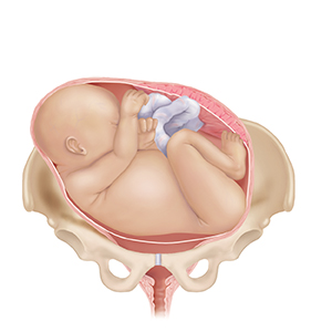 Front view of full-term fetus in uterus in pelvic bones with fetus' body lying sideways over birth canal, showing transverse position.