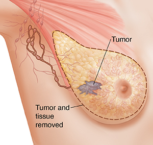 Three-quarter view of female underarm area showing breast anatomy ghosted in. Outline around tissue for simple mastectomy.