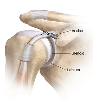 Front view of shoulder joint showing tear at top of labrum. Anchor placed to repair tear.