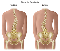 Ilustración de la escoliosis torácica y lumbar