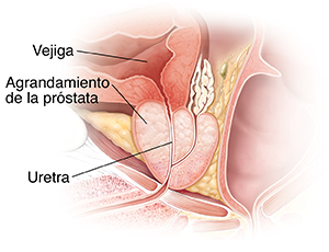 Corte transversal de una glándula prostática agrandada.