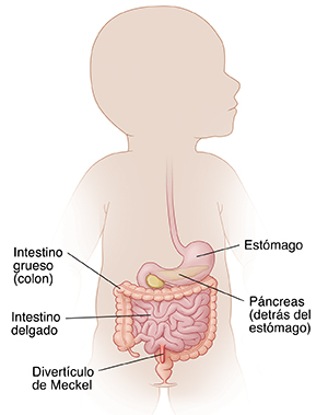 Contorno de un bebé donde pueden verse el aparato digestivo y la ubicación de un divertículo de Meckel.