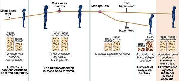 Gráfico que muestra el crecimiento óseo y la pérdida en el transcurso de vida de una mujer, con y sin tratamiento para la osteoporosis.