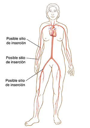 Silueta de una mujer en la que se ven los sitios por donde puede insertarse el catéter en la entrepierna y en el brazo.