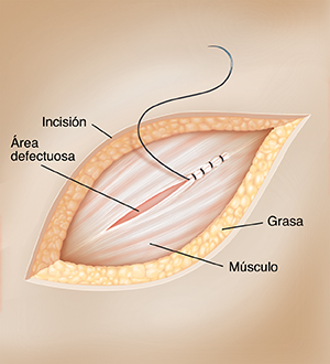 Piel con una incisión abierta que muestra un defecto en el músculo que se está suturando con una aguja quirúrgica.